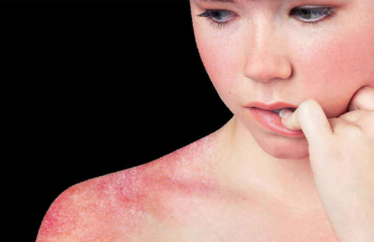 ¿Cuáles son las causas del lupus? Descúbrelas aquí